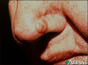 Skin cancer, basal cell carcinoma - nose