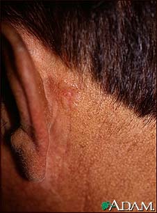 Skin cancer, basal cell carcinoma - behind ear