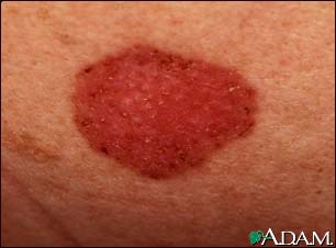 Skin cancer, basal cell carcinoma - spreading