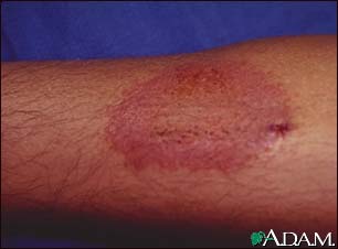 Dermatitis, contact