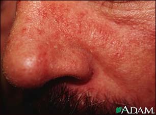 Dermatitis, seborrheic - close-up