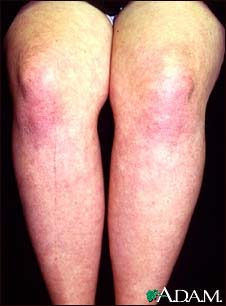 Dermatomyositis on the legs