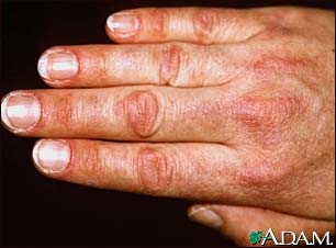 Dermatomyositis, Gottron's papule