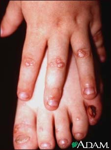 Epidermolysis bullosa, dominant dystrophic