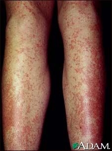 Drug rash, Tegretol