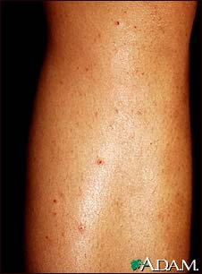 Folliculitis on the leg