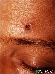 Histoplasmosis, disseminated in HIV patient