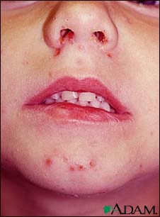 Impetigo on a child's face