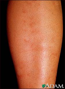 Polyarteritis, microscopic on the shin