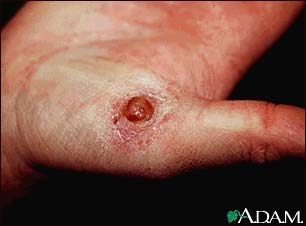 Pyogenic granuloma on the hand