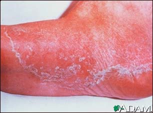 Athlete's foot, tinea pedis