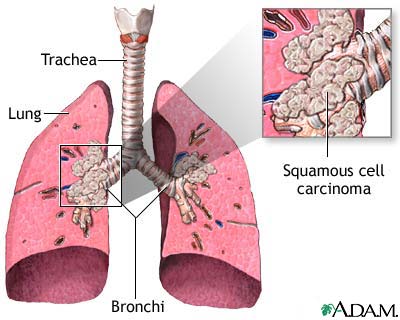 Squamous cell carcinoma