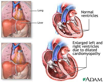 Alcoholic cardiomyopathy