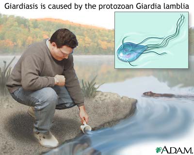 Giardiasis