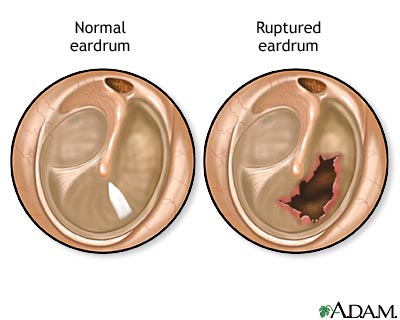 Ruptured eardrum